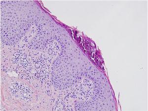 Hallazgos histológicos concordantes con psoriasis: se aprecia paraqueratosis, acantosis, microabscesos localizados en el estrato córneo e infiltrado linfohistiocitario localizado en la dermis papilar (hematoxilina-eosina, 200×).