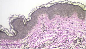 Verhoeff-van Gieson stain shows conserved oxytalan elastic fibers in the papillary and reticular dermis.