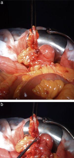a y b Plastrón a nivel de FID fosa iliaca derecha que engloba el apéndice con un orificio que corresponde a la fístula injerto apendicular.