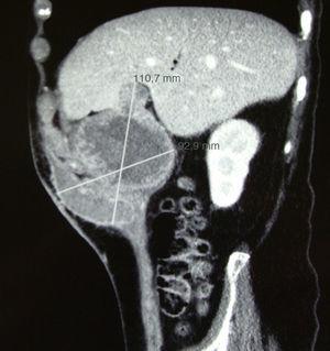 Tomografía computarizada abdominal corte sagital.