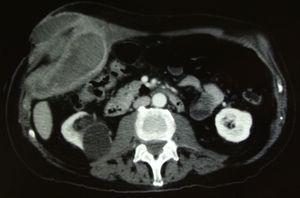 Tomografía computarizada abdominal corte transversal.