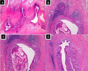 A) Múltiples «falsos» divertículos en borde mesentérico del extremo distal apendicular (HE, 4x). B y C) Pared diverticular constituida por mucosa y muscularis mucosae, empujando a la muscular propia y con formación de abscesos de eosinófilos. (HE, 20x). D) Divertículo ocupado por moco (mucocele) y con gran contenido en eosinófilos (HE, 40x).