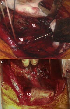 A) Cuerpo extraño perforando bronquio derecho. B) Bronquio derecho tras cierre primario y parche de trombina. RB: bronquio derecho; RL: pulmón derecho.