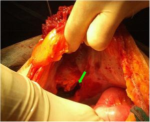Imagen de la cirugía mediante laparotomía de un paciente que sufrió herida abierta por asta de toro, con evisceración de colon y omento. La flecha muestra el orificio de entrada producido por el cuerno.