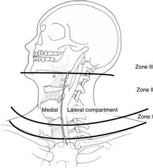 Zonas anatómicas del cuello. Fuente: Monson et al.69.