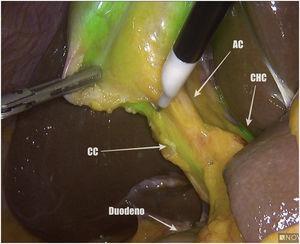 Visión anterior del triángulo de Calot previo a su disección e identificación de las estructuras biliares.AC: arteria cística; CC: conducto cístico; CHC: conducto hepático común.