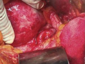 Disección de la arteria esplénica proximal al aneurisma mayor de 9cm.