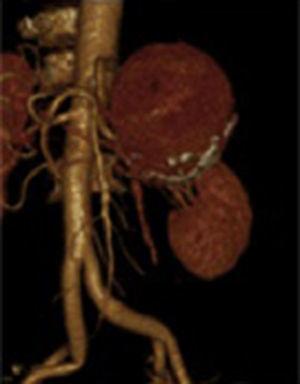 Reconstrucción amplificada en la cual se observa la lesión principal adherida al tronco celiaco y al trayecto de la arteria esplénica tangente al aneurisma.