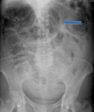 Radiografía simple de abdomen con dilatación de colon ascendente y transverso (flecha azul).