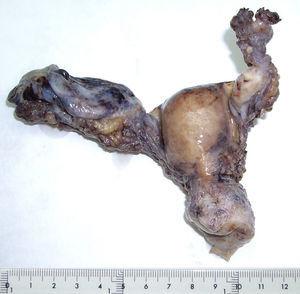 Imagen macroscópica tumor triple sincrónico: endometrio, ovario y trompa.