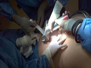 Procuración quirúrgica de piel.