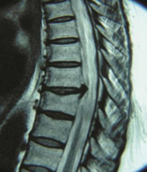 Resonancia magnética corte sagital: hernia comprometiendo la médula espinal. Caso 1.