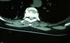 Tomografía corte axial en la que se evidencia hernia calcificada izquierda. Caso 2.
