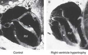 Right ventricle (RV) wall hypertrophy in rat fetuses exposed to indomethacin, compared with normal rats. Data from a previously published study.61
