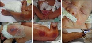 Iatrogenic skin lesions in preterm newborns. (A) Bruises. (B and C) Contact dermatitis by micropore. (D) Traumatic injury by skin adhesive. (E) Contact dermatitis by antiseptic. (F) Traumatic injury by identification bracelet.
