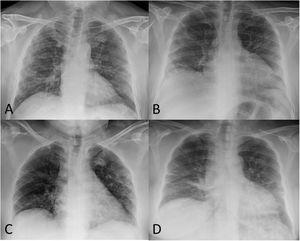 A) Varón de 52 años post-COVID-19 en cuya radiografía de tórax de seguimiento se observan opacidades reticulares subpleurales, más evidentes en el pulmón derecho. B) Varón de 51 años post-COVID-19 en cuya radiografía de tórax se identifica una importante pérdida de volumen de ambos pulmones y una afectación residual en forma de opacidades lineales subpleurales en el pulmón derecho. C) Mujer de 56 años post-COVID-19 en cuya radiografía de tórax de control se aprecia una pérdida de volumen de ambos pulmones, atelectasias laminares periféricas en el pulmón derecho y algunas opacidades subpleurales de atenuación en vidrio deslustrado en el pulmón superior izquierdo. D) Mujer de 58 años post-COVID-19 en cuya radiografía de tórax de seguimiento se visualizan opacidades “en banda” bibasales en relación con atelectasias laminares.