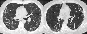 Los hallazgos más frecuentes en la tomografía computarizada de tórax (ventana de parénquima pulmonar) en los pacientes post-COVID-19 con secuelas radiológicas son las bandas parenquimatosas subpleurales (“opacidades en banda” y “líneas subpleurales”, flechas largas) con distorsión de la arquitectura pulmonar y dilataciones bronquiales secundarias (flechas cortas).