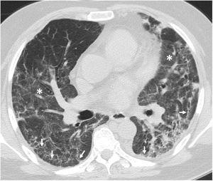 Tomografía computarizada de tórax (ventana de parénquima pulmonar) en paciente post-COVID-19 que muestra opacidades bilaterales de atenuación en vidrio deslustrado (asteriscos) asociadas a reticulación grosera subpleural (flechas).