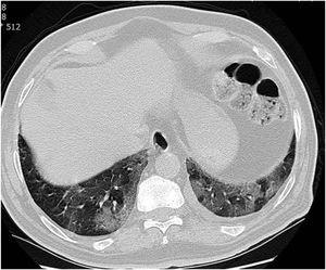 Una TC axial de tórax con ventana pulmonar sin contraste muestra una opacidad en empedrado en la base de ambos pulmones en un paciente con neumonía por COVID-19.