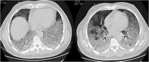 Dos TC axiales de tórax con ventana pulmonar sin contraste muestra una opacidad en empedrado en la base de ambos pulmones en un paciente con neumonía por COVID-19.