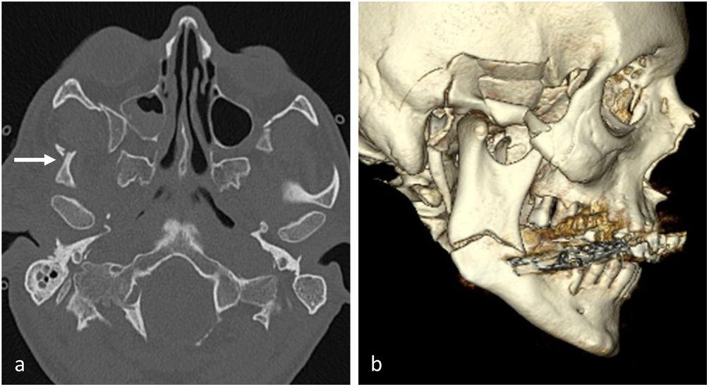 Radiografia de maxilar y mandibula