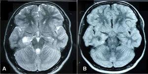 Resonancia magnética cerebral, corte transversal, con evidencia de lesión ocupante de espacio en el lóbulo temporal derecho. A: potenciada en secuencia T2. B: potenciada en secuencia FLAIR.