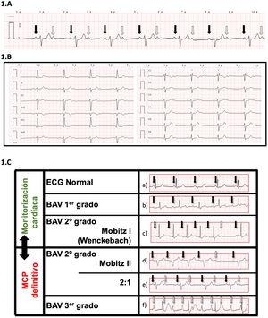 ECG de la paciente que muestra un BAV tipo 2:1 en la derivación DII A) (flecha continua, onda P que conduce; flecha discontinua, onda P no conduce); y en todas sus derivaciones B). En la mayoría de las ocasiones, este bloqueo cardíaco es considerado de elevado riesgo a BAV completo y frecuentemente se indica el implante de MCP definitivo, especialmente en presencia de un QRS con morfología de bloqueo de rama. Ante una urgencia quirúrgica, se debe valorar la colocación de MCP temporal (electrocatéter). La imagen C) muestra del ECG en su derivación DII de los distintos tipos de BAV. Se indica de forma visual la recomendación de implante de MCP previo al procedimiento quirúrgico. a) ECG normal: todas las ondas P conducen. PR <200 msg. b) BAV 1.er grado: todas las ondas P conducen. PR> 200 msg. BAV 2.° grado: algunas ondas P conducen. c) Tipo Mobitz I (Wenckebach): alargamiento progresivo del intervalo PR hasta la ausencia de conducción. d) Tipo Mobitz II: PR constante. Con ondas P sin conducción AV. e) Tipo 2:1: onda P con conducción AV intermitente (1 conduce y otra no). Típicamente con FC de 40-50 x́. f) BAV 3.er grado (completo): ausencia de conducción AV de la onda P. Habitualmente con bradicardia extrema (30-35x́) y QRS ancho. (Flecha continua, onda P que conduce; flecha discontinua, onda P no conduce).