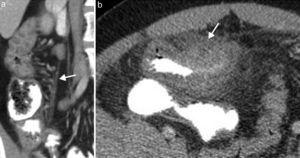 Enfermedad de Crohn con cambios inflamatorios agudos en paciente de 55 años. (a) Imagen coronal de tomografía de abdomen que demuestra ingurgitación de los vasos mesentéricos (flecha) y (b) engrosamiento de las paredes del íleon distal asociado a alteración de la densidad de la grasa adyacente (flecha).
