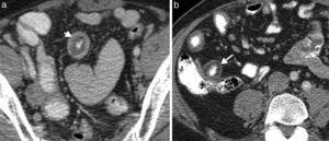 Enfermedad de Crohn en fase crónica. (a y b) Imágenes axiales de la enterografía por tomografía computada que identifican un depósito de grasa en la submucosa con una apariencia trilaminar de la pared intestinal (flechas).