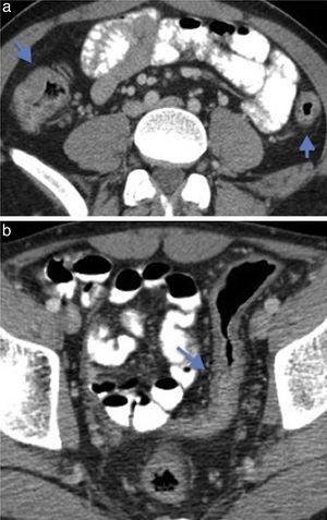 Enfermedad de Crohn en paciente de 21 años en estadio crónico. (a y b) Imágenes axiales de enterografía por tomografía computada identifican un engrosamiento de las paredes del colon ascendente, descendente y sigmoide (flechas).