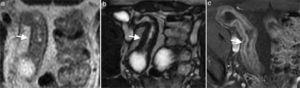 Enfermedad de Crohn en fase crónica en paciente de 55 de años. (a y b) Imágenes axiales de enterografía por resonancia magnética ponderadas en T2 y (c) poscontraste que presentan baja señal en secuencias ponderadas en T2 en la mucosa y la submucosa, asociada a estenosis luminal y realce tardío por cambios fibróticos (flechas).