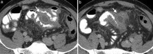 Paciente con enfermedad de Crohn en fase penetrante. (a y b) Imágenes axiales de enterografía por tomografía computada que muestran una colección interasas con realce de la pared que corresponde a absceso (flechas).