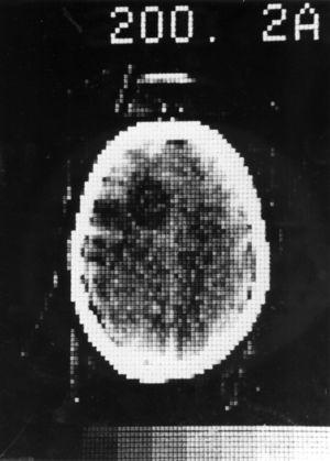 Primera tomografía computada, 1972 (cortesía de A. Thomas, Reino Unido).