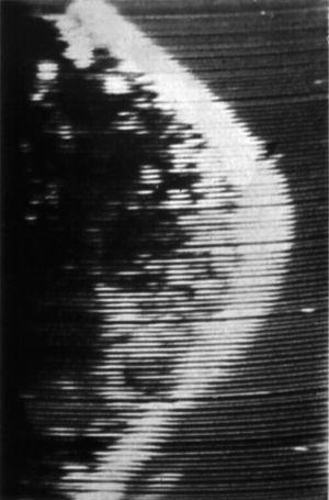 Primera ecografía de mama tomada por un ecógrafo en tiempo real (1962).