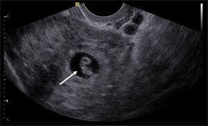 Embrión sin evidencia de actividad cardíaca (flecha), dentro de un anillo tubario (tipo I).