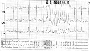 Episodios frecuentes de taquicardia ventricular polimórfica no sostenida con fenómenos de R sobre T.