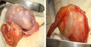 Se identifica parénquima testicular con múltiples nódulos en su superficie al corte color blanco claro.