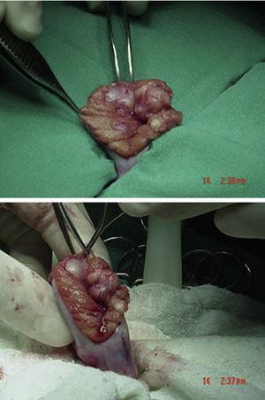 La biopsia evidencia múltiples lesiones nodulares que remplazan el parénquima testicular.