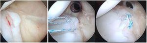 (De izquierda a derecha): Visualización de lesión del labrum posterior desde el portal anterosuperior / Paso de suturas para reparación de lesión labral / Reparación de lesión del labrum posterior.