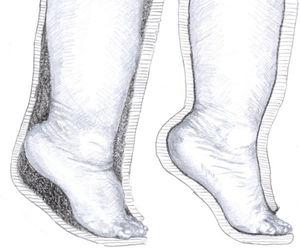 A la izquierda: Deslizamiento proximal del pie dentro del yeso que favorece el desarrollo de deformidades en equino y cavo. A la derecha: yeso adecuadamente moldeado en el tobillo y el talón que evita desplazamientos.