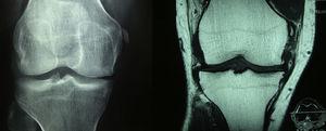 A la izquierda en la radiografía AP de rodillas se observa calcificación del ligamento colateral medial en su parte proximal, además de disminución del espacio femorotibial medial. A la derecha en la adquisición coronal con información T1 de la rodilla se hace evidente una osificación en el extremo proximal del ligamento colateral medial, en relación con una lesión antigua, configurando una lesión de Pellegrini-Stieda. Se observan además cambios artrósicos por formación de osteofitos marginales en el compartimento medial.
