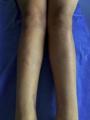 Lesiones crónicas de esclerodermia linear en extremidades inferiores.