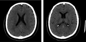Tomografía de cráneo (10/07/2020): pequeñas imágenes hipodensas de ganglio basales a nivel de la cabeza del núcleo caudado izquierdo que también se alcanzan a visualizar en la región del antemuro izquierdo.