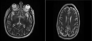 Resonancia magnética cerebral (12/07/2020): estudio dentro de límites normales.