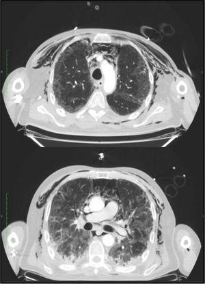 Tomografía computarizada de tórax que demuestra la presencia de neumomediastino y enfisema subcutáneo; adicionalmente, opacidades en vidrio esmerilado de forma bilateral.