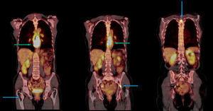 Cortes coronales que identifican focos hipermetabólicos metastásicos en el esqueleto (flechas azules), compromiso hiperglicolítico intenso del tercio medio e inferior del esófago por el carcinoma escamocelular.