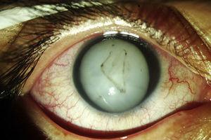 Imagen clínica del ojo derecho a la presentación del paciente.