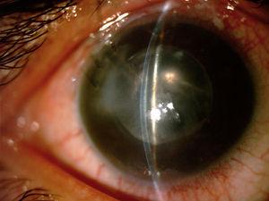 Imagen clínica del ojo derecho 3 semanas después de realizado el implante valvular.