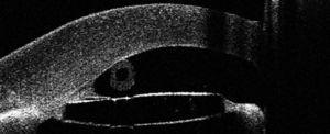 Tomografía de coherencia óptica visante mostrando toque endotelial del tubo valvular.