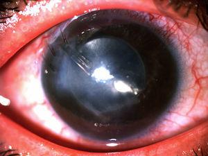 Imagen clínica mostrando edema corneal persistente.